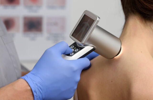 badanie skóry dermatoskopia